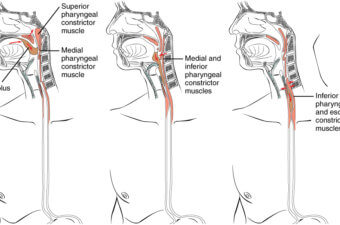 Identifying Dysphagia